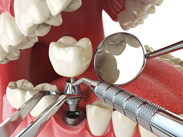 Best Broken or Chipped Tooth Repair in Keene, NH