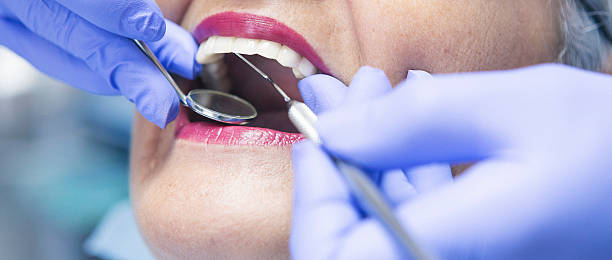 Best Knocked-Out Tooth (Avulsed Tooth) Treatment in Keene, NH